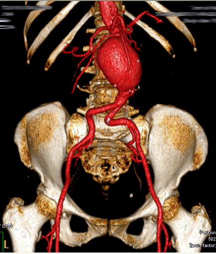 Aneurisma da Aorta Abdominal – AAA