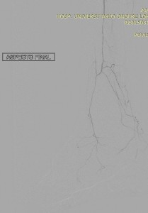 Recanalização retrógrada da artéria Fibular para tratar isquemia do pé