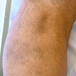 Hemossiderina