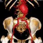 Aneurisma da Aorta abdominal