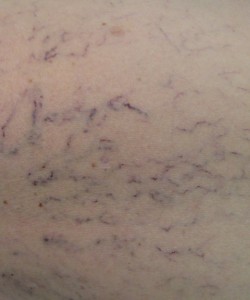 Microvarizes ou Telangiectasias