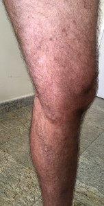 Um ano após a cirurgia.